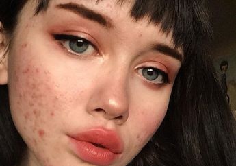 Ini Penyebab Timbulnya Jerawat di Wajah. Jerawat Hidung Karena Makanan Pedas?!