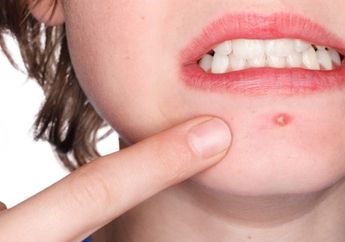 Bukan Dipencet, Ini 4 Cara Cepat Atasi Jerawat Nanah Biar Tak Berbekas