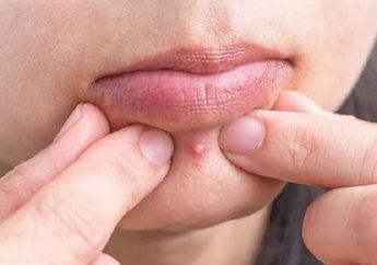 Acne Spot Treatment Lokal, Solusi Jerawat Mateng Kempes