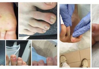 Sejumlah Pasien Covid Alami Ruam di Kaki, Apakah Ini Gejala Baru Virus Corona?