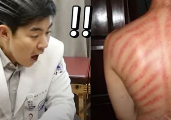 Baru Tahu Orang Indonesia Obati Masuk Angin Pakai Kerokan, Dirut Rumah Sakit Korea Selatan Syok Sekaligus Takjub: Bagaimana Bisa Simetris Begini?