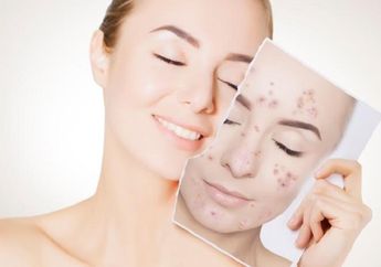 Nggak Mudik Tetap Cantik, Ketahui Penyebab dan Cara Atasi Bintik Hitam di Wajah