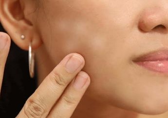 Beda Tipis Antara Panu dan Uneven Skin Tone Pada Wajah Beda Tipis, Ini Cara Mudah Bedakannya