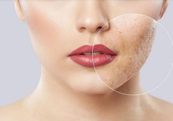 Samarkan Bopeng di Wajah Tanpa ke Dokter Kulit, Ini 3 Pilihan Serum Anti Kantong Jebol