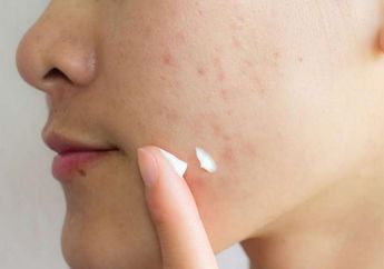 Skin Care Kulit Wajah Berjerawat Wajib Mengandung Salicylic Acid, Ini Loh Manfaatnya