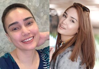 Feby Febiola Idap Penyakit Kista hingga Rela Rambutnya Dibondol, Ternyata Makanan yang Sering Terhidang di Meja Makan ini Bisa jadi Penyebabnya