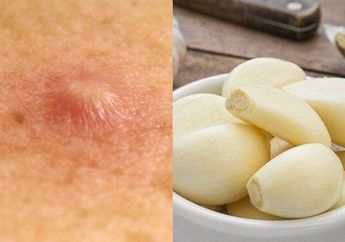 Enggak Perlu Pakai Salep, Bisul Bisa Hilang Seketika Cuma dengan Bawang Putih! Begini Cara Pakainya