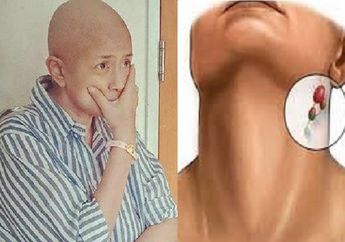 Jadi Kanker Paling Mematikan Hingga Renggut Nyawa Ria Irawan, Catat Baik-baik Gejala Kanker Getah Bening yang Tidak Kita Sadari Ini