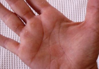 4 Tips Alami Hilangkan Kapalan, Ramuannya Bisa Dibuat Sendiri