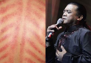 Didi Kempot Sempat Kerokan Sebelum Tiba-tiba Alami Serangan Jantung, Benarkah Kerokan Ternyata Bisa Begitu Berbahaya?