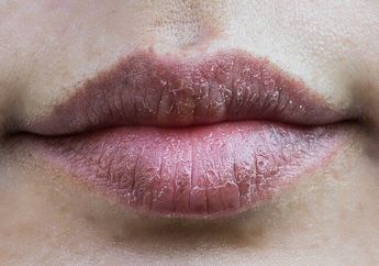 Punya Bibir Pecah-pecah? Ini Dia 5 Cara Alami yang Bisa Kita Lakukan!