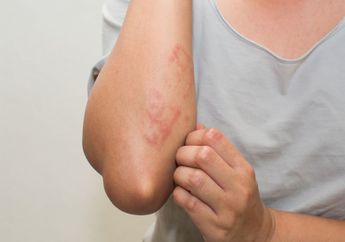 Termasuk Lidah Buaya, Ini 3 Obat Biduran Alami untuk Meredakan Gatal-gatal