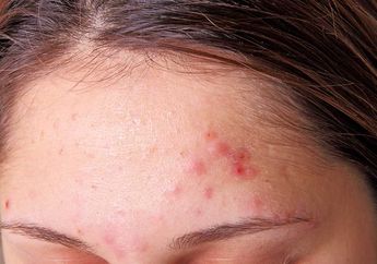 Tak Usah Skincare, Basmi Bruntusan Pakai 5 Bahan Alami Ini Aja!