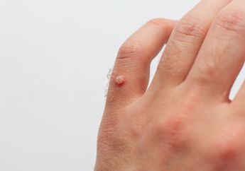 Punya Papiloma Jadi Bikin Tak Percaya Diri? Hilangkan dengan Bahan-bahan Rumahan Ini