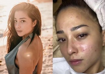 Korban DIY Bahan Alami di Youtube, Lihat Deretan Kondisi Wajah Nikita Willy dengan Kondisi Jerawat yang Makin Parah!