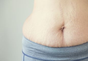 Cara Hilangkan Stretch Mark Pasca Melahirkan Tanpa Obat Kimia dan Herbal