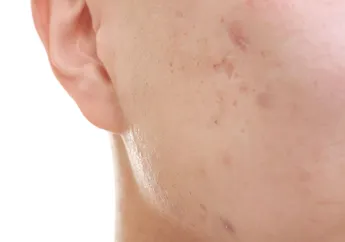 4 Sabun Cuci Muka di Bawah 25 Ribu Ampuh Hilangkan Noda Bekas Jerawat!