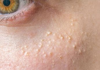 Cara Menghilangkan Milia dengan Cepat, Pakai 4 Produk Skincare Ini!
