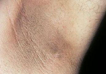Selama Ini Dianggap Sepele! Ketiak Hitam Bisa Jadi Tanda Awal Tubuh Terserang Penyakit Mematikan, Wajib Banget Tahu