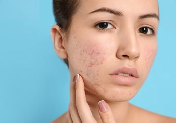 Bikin Flawless, 4 Krim Pagi Murah Ini Bisa Pudarkan Bekas Jerawat!
