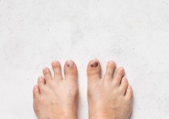 Tanda Awal Ulkus Diabetikum, Penyakit Infeksi Kaki Diabetes, Serta Cara Pencegahannya