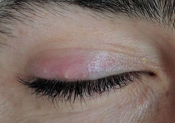 Mata Bintitan? Enggak Bersihkan Make-Up dan 3 Hal Ini Penyebabnya!