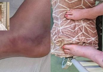 Dikira Cuma Injak Cacing, Bocah 11 Tahun Ini Justru Alami Kenyataan Pilu Saat Kakinya Membengkak hingga 3 Kali Lipat, Dokter Ungkap Fakta Mencengangkan