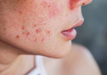Kosmetik Bagi yang Kulitnya Berjerawat, Untuk Pria dan Wanita