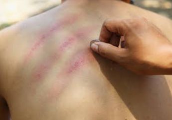 Para Istri Harus Catat Kalau Sayang Suami! Jangan Sekali-Kali Coba Kerokan di Bagian Tubuh Ini, Bisa Sebabkan Kematian Detik Itu Juga