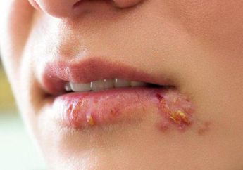Pengobatan Herpes Simpleks Harus Sesuai Anjuran Dokter Agar Tak Muncul Komplikasi
