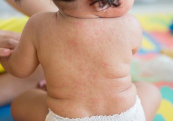 Gejala Infeksi Roseola yang Sering Terjadi Pada Bayi, Orangtua Perlu Tahu