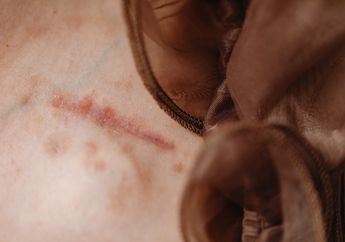 Tak Perlu Keluarkan Uang untuk Perawatan Mahal, Menghilangkan Keloid Bisa Dilakukan dengan Cepat Cuma Modal Cuka Sari Apel dan Lemon