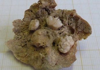 Heboh Temuan Tumor Ovarium yang DItumbuhi Gigi di Makam Gereja