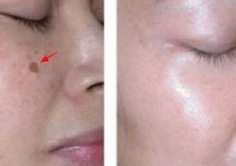 Bertahun-tahun Frustasi Tahan Malu, Flek Hitam Bisa Pudar dengan Cepat Cuma Modal 1 Labu Siam, Prakteknya Gampang Banget!