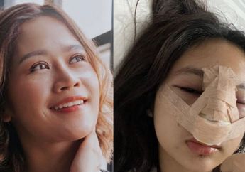 Bekas Operasi Plastik di Hidungnya Makin Lama Tambah Nyeri hingga Bengkak Kemerahan, Anak Farida Nurhan Cerita Alami Hal Mengerikan Ini, Permesta Dhyaz Sampai Dilarang Begini