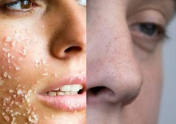 BERITA POPULER : Cara Menghilangkan Bekas Jerawat dengan Gula Sampai Rontokkan Komedo dengan Baking Soda