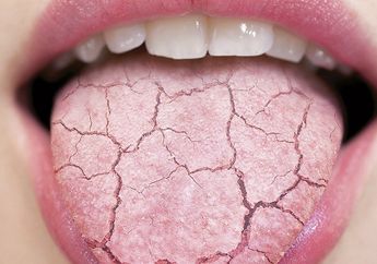 5 Tanda-tanda Mulut Kering Akibat Diabetes dan Cara Mengatasinya