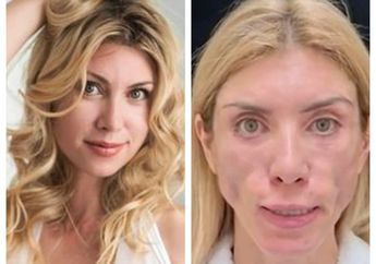 Dulu Punya Wajah Cantik Mempesona, Ratu Kecantikan Asal Rusia Ini Justru Alami Kengerian Tak Bisa Senyum dan Terpejam Usai Facelift Rp 49 juta