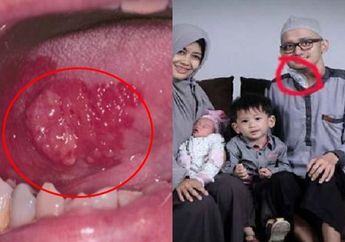 Kisah Pria Ini Viral Setelah Meninggal Karena Kanker Lidah, Sang Istri Jujur Menyesel Tak Larang Suami Konsumsi Makanan yang Jadi Penyebabnya Ini