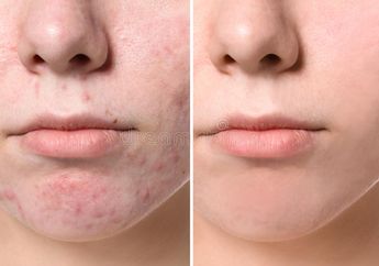 Skincare Korea Mah Lewat! Cuma Pakai Pisang Bisa Hilangkan Bekas Jerawat Menahun di Wajah, Lalat pun Bisa Kepeleset Saking Mulusnya Wajah
