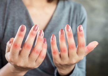 Dijamin Gratis, Ini Cara Dapatkan Pengobatan Penyakit Lupus dengan BPJS