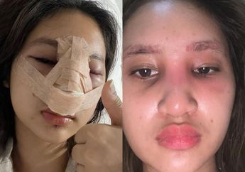 'Pertamanya Nyeri' Astaga! Sempat Dihujat Habis-habisan Dituding Tak Bersyukur Gegara Lakukan Operasi Plastik, Anak Farida Nurhan Kini Alami Hal Mengerikan pada Hidungnya