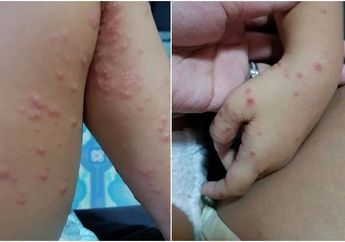 Hati-hati Waspada Flu Singapura Ini Gejala Cara Mendeteksi hingga Penularannya