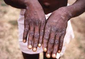 Bak Seolah Ikut Bikin WHO Kebakaran Jengggot Lagi, Penyakit Langka Mendadak Muncul, Sudah Menyebar dari Afrika hingga Eropa, Bahkan Sudah Sampai Israel