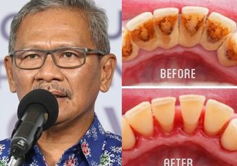 BERITA POPULER : Makanan Penyebab Kanker Usus yang Diderita Achmad Yurianto Sampai Cara Merontokkan Karang Gigi dengan Sirih
