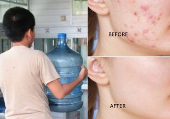 Yang Sering Beli Skincare Pas Promo Pasti Shock Kalau Tahu, Wanita ini Sukses Hilangkan Jerawat Cuma Modal Air Isi Ulang