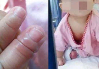 Sangat Pilu, Seorang Ibu Menceritakan Tentang Bayinya yang Kena Sindrom Hair Tourniquet, Berikan Peringatan kepada Ibu Lain