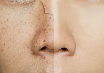 Tak Perlu Mahal-Mahal Beli Skincare, Flek Hitam Bisa Hilang Pakai Bawang Merah