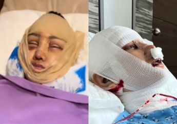 Innalillahi, Kondisi Lucinta Luna Memburuk Hingga Berdarah-darah