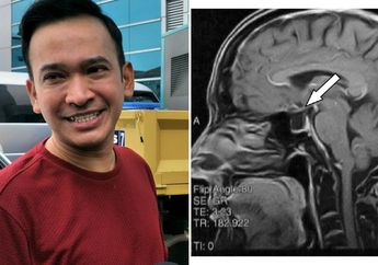 Mengenal Lebih Jauh Empty Sella Syndrome, Penyakit Langka yang Diidap Ruben Onsu, Ini Gejala-gejala yang Umumnya Dirasakan
